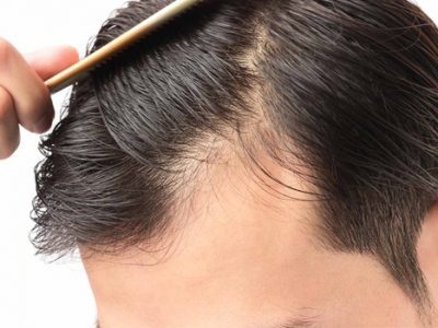 7 Tips for Hair Loss Prevention – Stop Balding