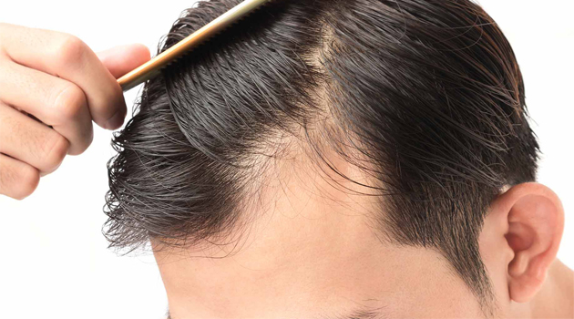 7 Tips for Hair Loss Prevention – Stop Balding