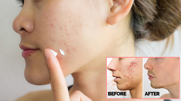 acne scares