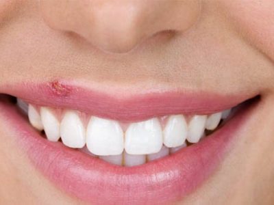 Home Remedies for Cold Sores