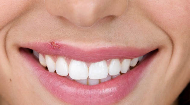 Home Remedies for Cold Sores