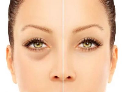 home remedies for dark circles