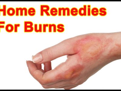 Home Remedies for Burns