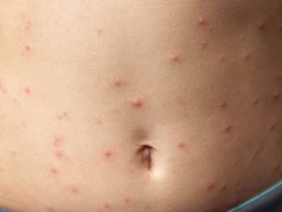 home remedies for skin rashes