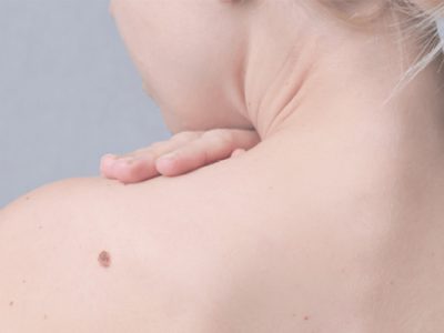 Skin Tags Using Baking Soda And Castor Oil