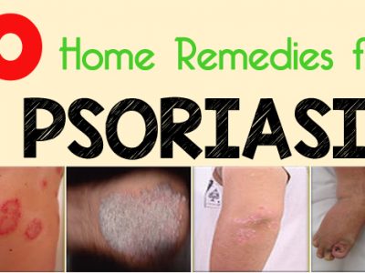 10 Home Remedies for Psoriasis