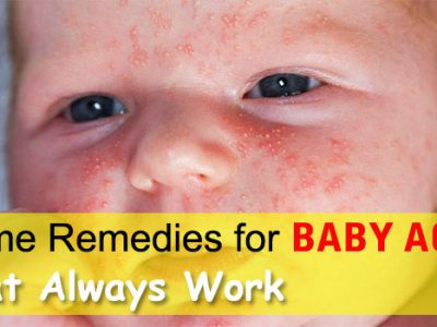 Remedies for Baby Acne