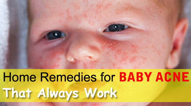 Remedies for Baby Acne