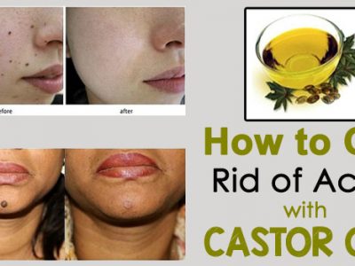 How to Get Rid of Acne with Castor Oil