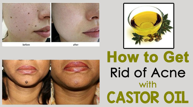 How to Get Rid of Acne with Castor Oil
