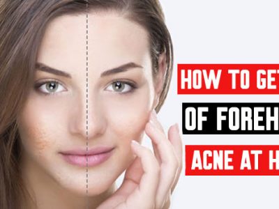 Forehead Acne