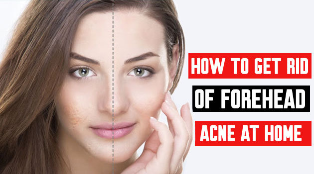 Forehead Acne