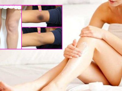 How to get rid of Dark Knees and Elbows