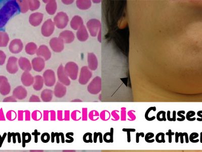 Mononucleosis Causes, Symptoms