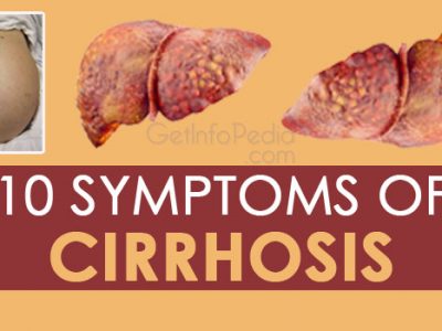 10 Symptoms of Cirrhosis