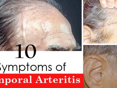 10 Symptoms of Temporal Arteritis