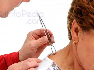 6 Symptoms of Lyme Disease