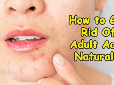 Get Rid Of Adult Acne Naturally