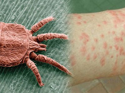 Get Rid of Chigger Bites Naturally