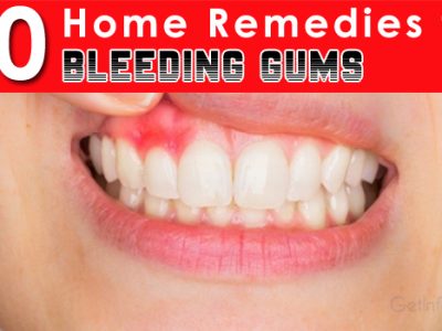 Bleeding Gums