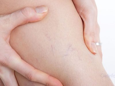 Varicose Veins