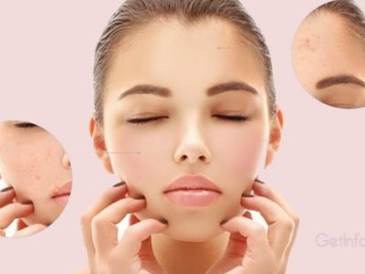 Top 15 Home Remedies to Get Rid of Open Pores