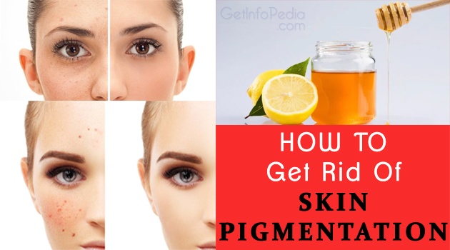 Skin Pigmentation