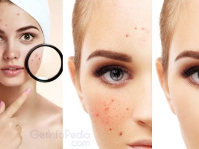 home remedies for dark spots