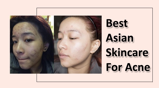 Best Asian Skincare for Acne