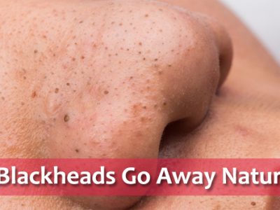 Do Blackheads Go Away Naturally