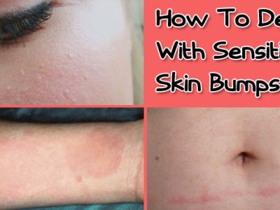 Sensitive Skin Bumps