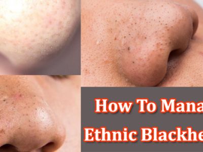 ethnic blackheads