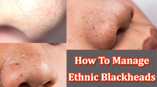 ethnic blackheads