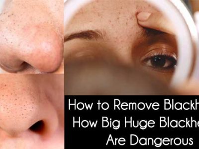 remove blackheads