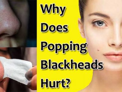 Popping Blackheads Hurt?