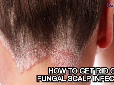 How to Get Rid Of Fungal Scalp Infection