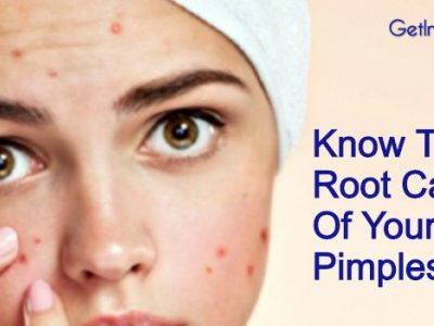 pimples