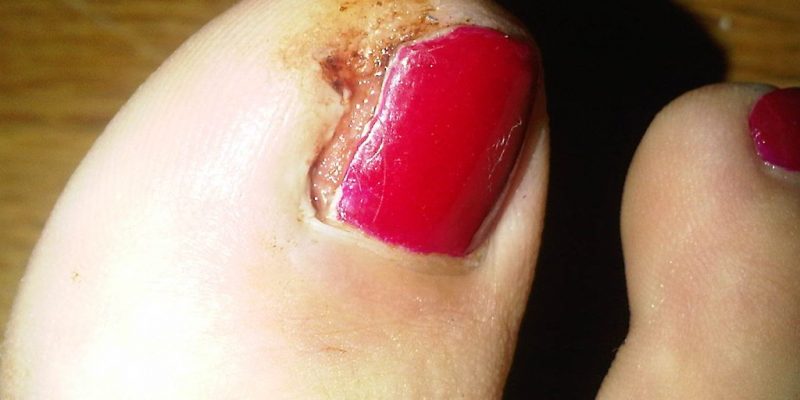 Ingrown Toenail