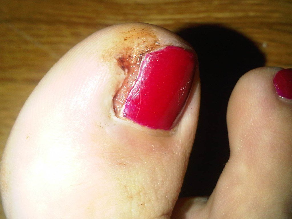 4 Easy Steps to Help Remove an Ingrown Toenail Ingrown Toenail