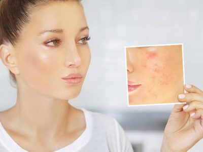 10 Foods That Cause Acne