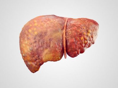 Fatty Liver Disease