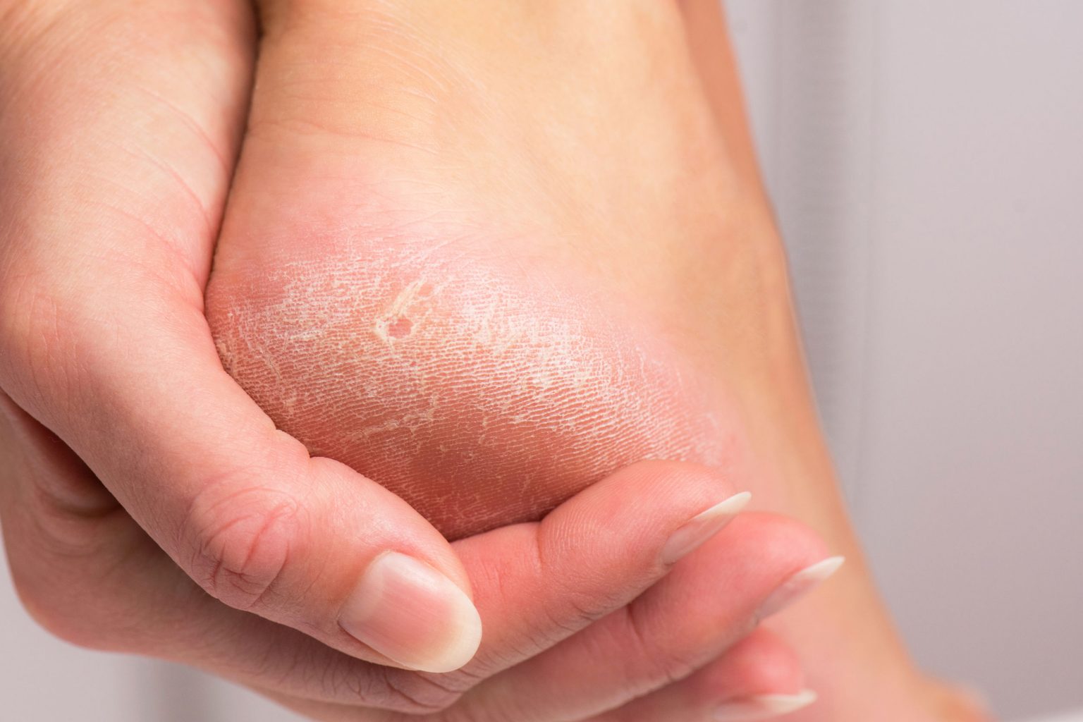 7 Ways to Get Rid of Calluses Without Pain Calluses