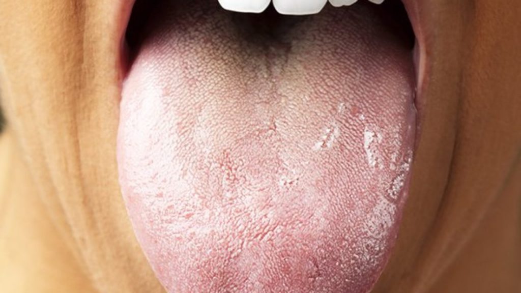 How to Get Rid of White Tongue Naturally