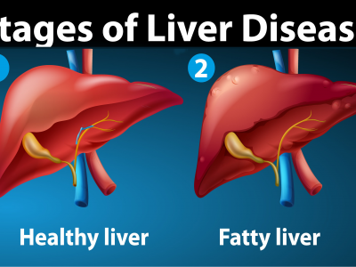 Foods to Treat Fatty Liver | Fatty Liver Disease